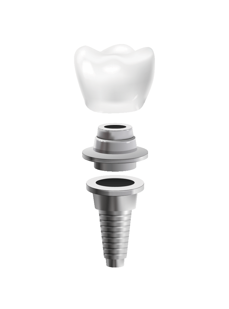 Implant Crown