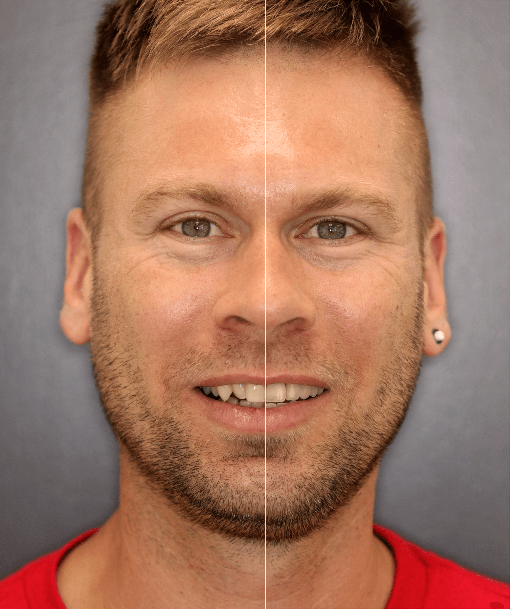 Complete smile makeover showcase