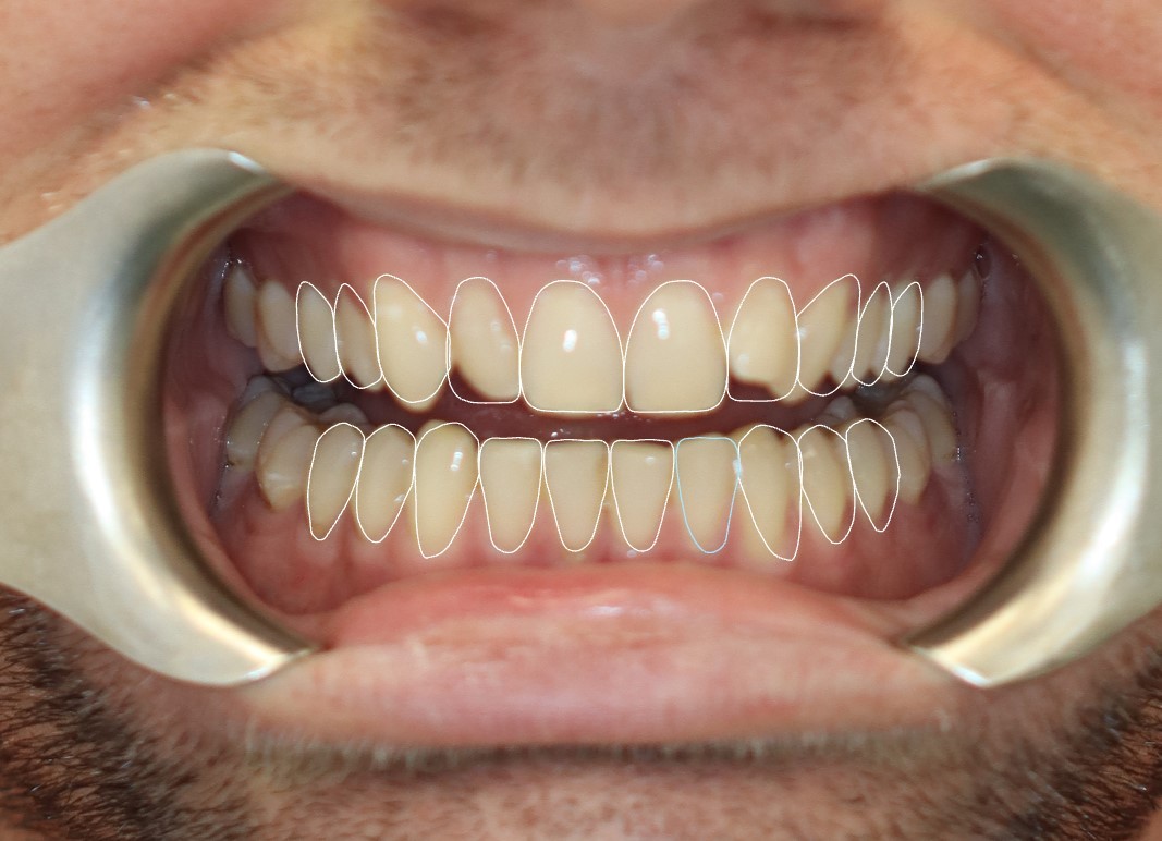 After treatment view 2