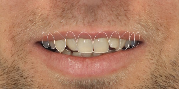 After treatment view 3